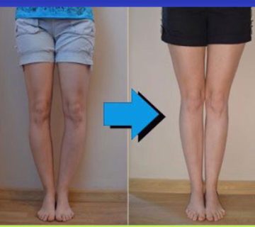 پای پرانتزی یا ژنوواروم