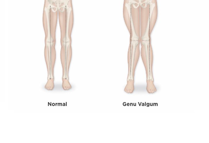Genu vagum 1 729x500